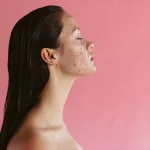 Fungal Akne – was ist das und wie kann man sie loswerden?